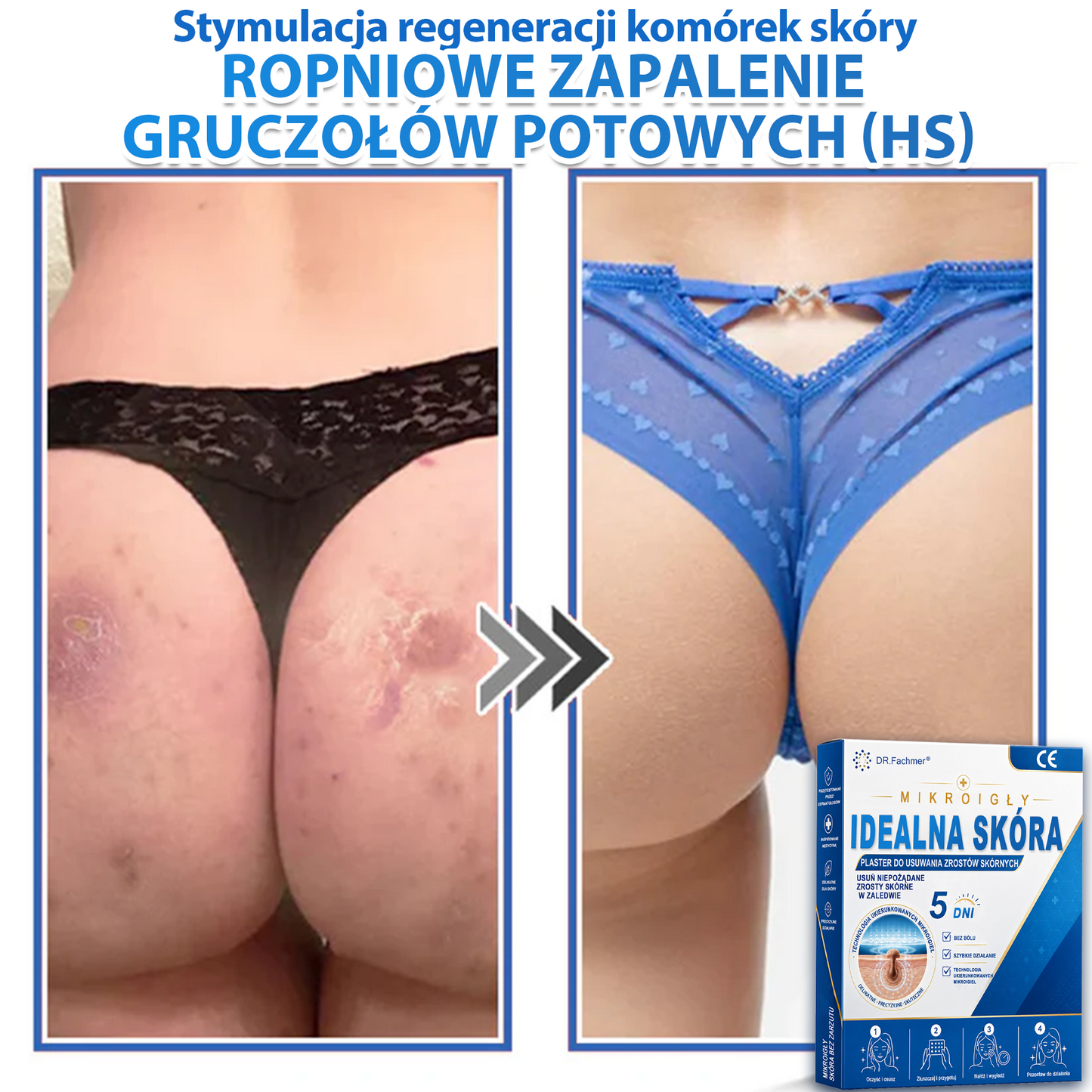 ✅📖 DR.Fachmer® Plaster mikroigłowy i hydrokoloid 2 w 1 | 👉Usuwające znamiona, trądzik, płaskie brodawki i zmiany skórne | Poprawia zmarszczki, blizny i przebarwienia | Niewidoczne plastry na pryszcze na twarz i ciało