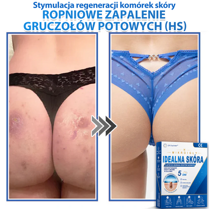 ✅📖 DR.Fachmer® Plaster mikroigłowy i hydrokoloid 2 w 1 | 👉Usuwające znamiona, trądzik, płaskie brodawki i zmiany skórne | Poprawia zmarszczki, blizny i przebarwienia | Niewidoczne plastry na pryszcze na twarz i ciało