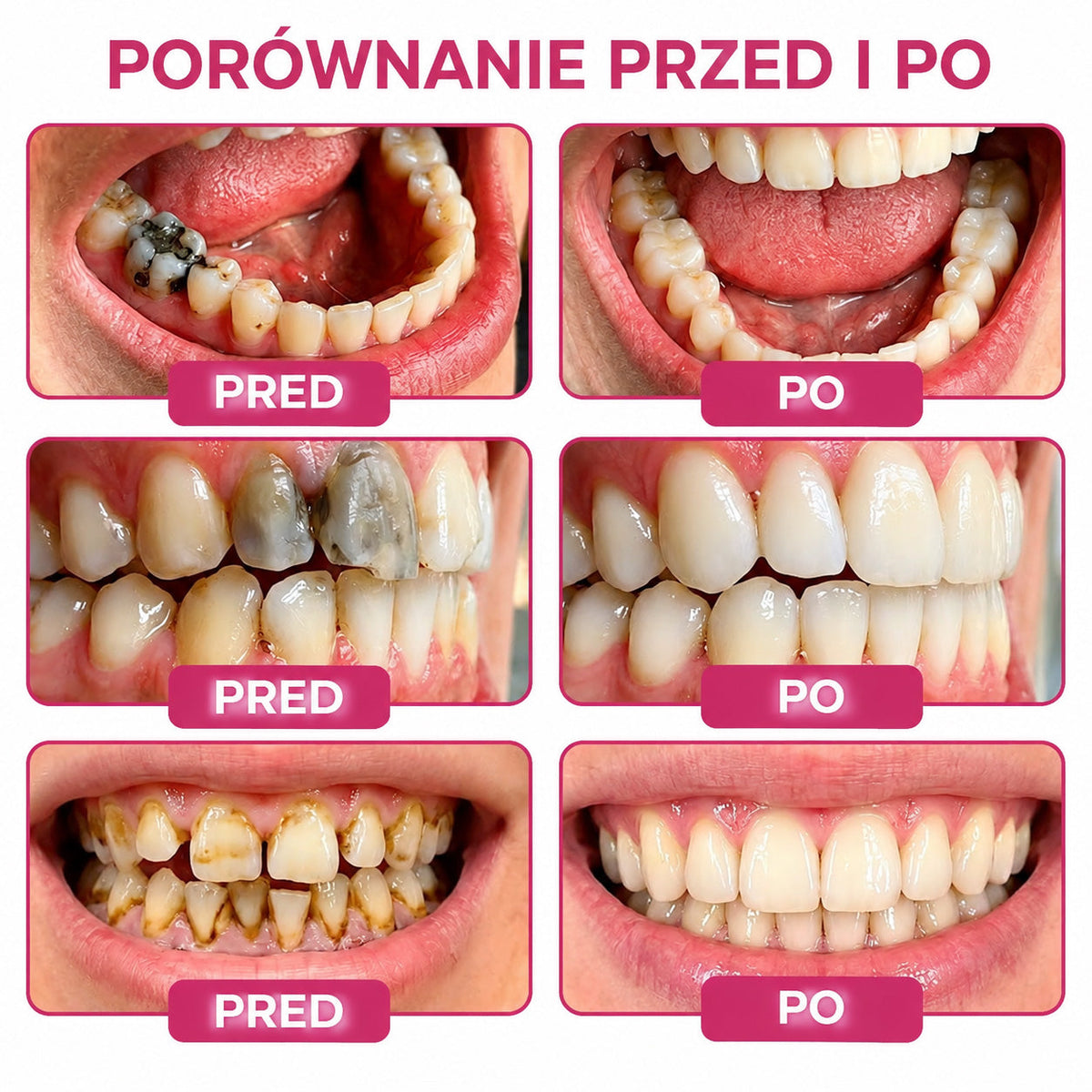 🧑‍⚕️Trilumia® 🦷 DenPerm – Naturalny żel do odbudowy szkliwa i wypełniania ubytków próchnicowych 🧊