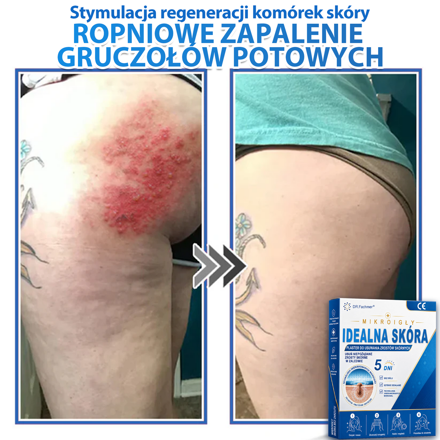 ✅📖 DR.Fachmer® Plaster mikroigłowy i hydrokoloid 2 w 1 | 👉Usuwające znamiona, trądzik, płaskie brodawki i zmiany skórne | Poprawia zmarszczki, blizny i przebarwienia | Niewidoczne plastry na pryszcze na twarz i ciało