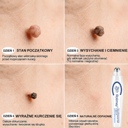 💖Oficjalny Sklep Markowy | ✅👩‍⚕️ Rolimey® 7-Dniowy 𝗧𝗮𝗴 & 𝗦𝗽𝗼𝐭 𝐄𝐫𝐚𝐬𝐞𝐫 (Bez bólu, Bez blizn – aplikator z kulką) 💖