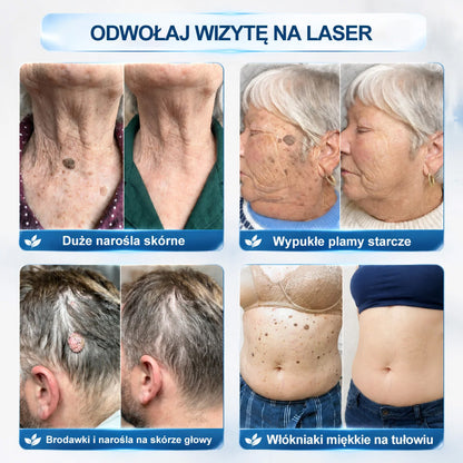 💛Oficjalny Sklep Markowy | ✅👩‍⚕️ Rolimey® 7-Dniowy 𝗧𝗮𝗴 & 𝗦𝗽𝗼𝐭 𝐄𝐫𝐚𝐬𝐞𝐫 (Bez bólu, Bez blizn – aplikator z kulką) 💛