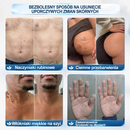 💛Oficjalny Sklep Markowy | ✅👩‍⚕️ Rolimey® 7-Dniowy 𝗧𝗮𝗴 & 𝗦𝗽𝗼𝐭 𝐄𝐫𝐚𝐬𝐞𝐫 (Bez bólu, Bez blizn – aplikator z kulką) 💛