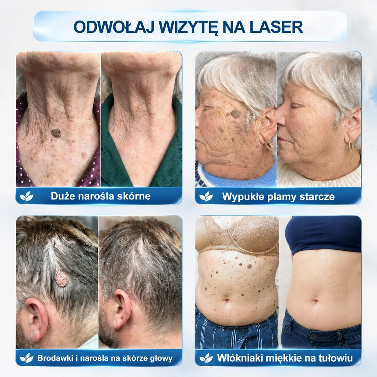 💖Oficjalny Sklep Markowy | ✅👩‍⚕️ Rolimey® 7-Dniowy 𝗧𝗮𝗴 & 𝗦𝗽𝗼𝐭 𝐄𝐫𝐚𝐬𝐞𝐫 (Bez bólu, Bez blizn – aplikator z kulką) 💖