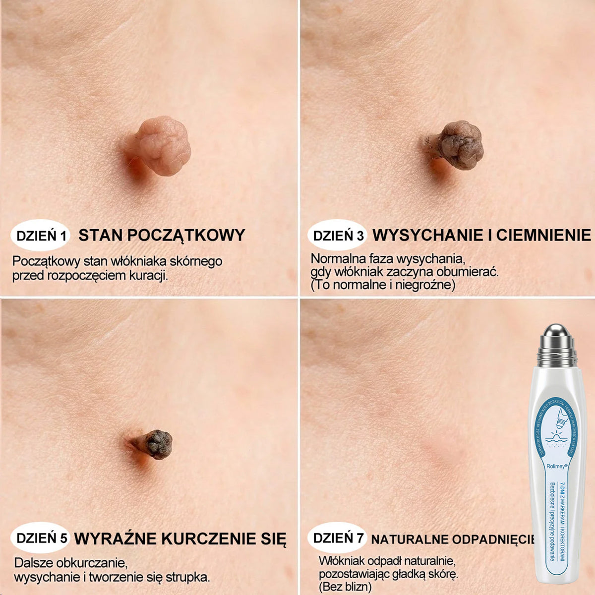 💛Oficjalny Sklep Markowy | ✅👩‍⚕️ Rolimey® 7-Dniowy 𝗧𝗮𝗴 & 𝗦𝗽𝗼𝐭 𝐄𝐫𝐚𝐬𝐞𝐫 (Bez bólu, Bez blizn – aplikator z kulką) 💛
