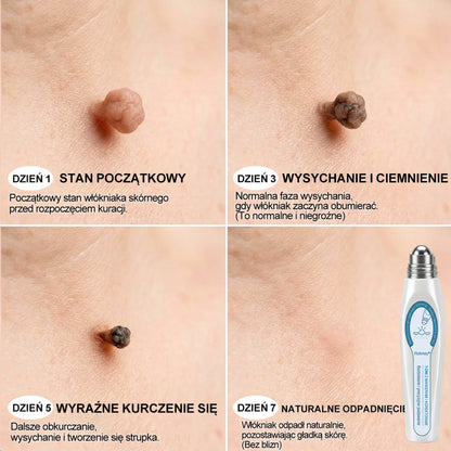 💛Oficjalny Sklep Markowy | ✅👩‍⚕️ Rolimey® 7-Dniowy 𝗧𝗮𝗴 & 𝗦𝗽𝗼𝐭 𝐄𝐫𝐚𝐬𝐞𝐫 (Bez bólu, Bez blizn – aplikator z kulką) 💛