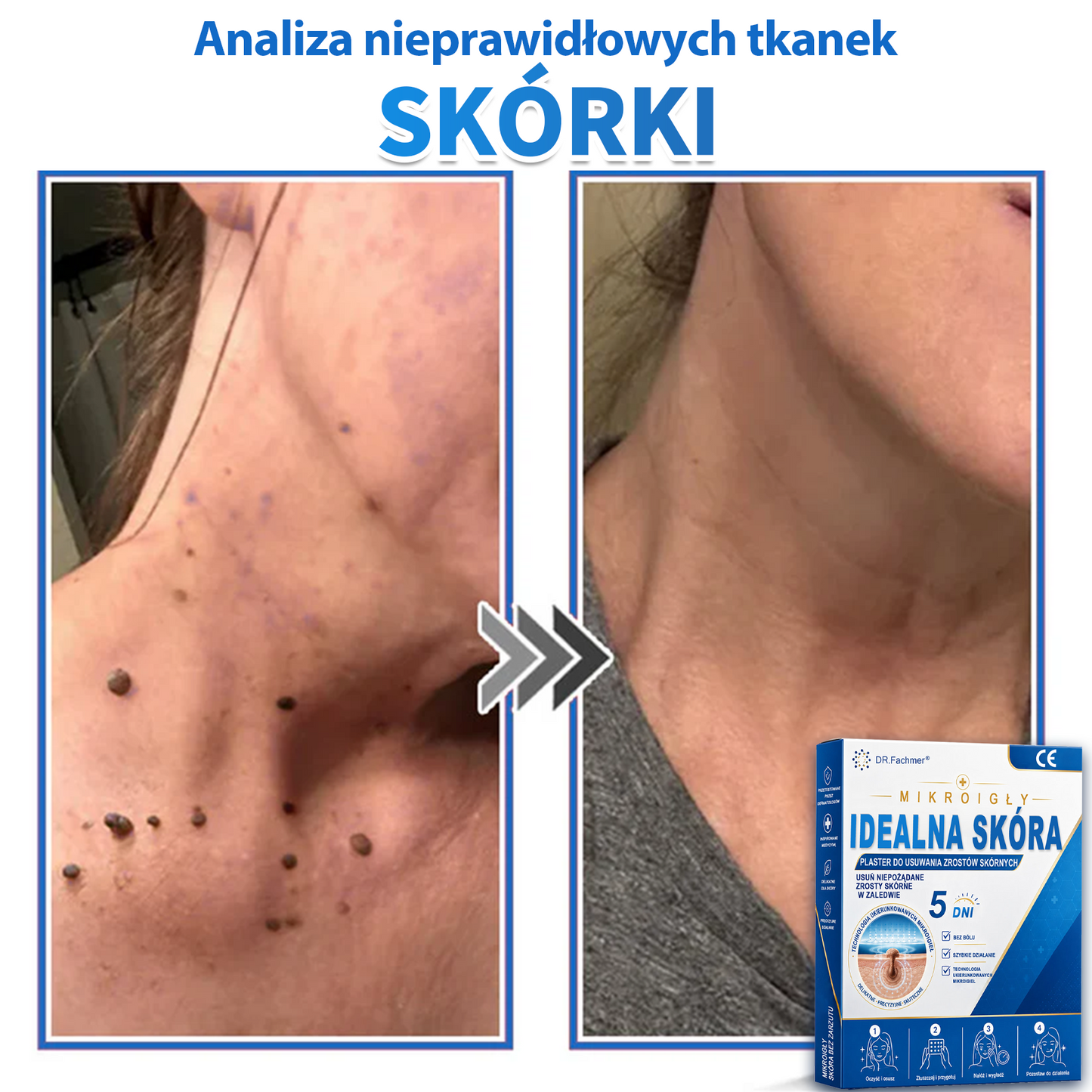 ✅📖 DR.Fachmer® Plaster mikroigłowy i hydrokoloid 2 w 1 | 👉Usuwające znamiona, trądzik, płaskie brodawki i zmiany skórne | Poprawia zmarszczki, blizny i przebarwienia | Niewidoczne plastry na pryszcze na twarz i ciało