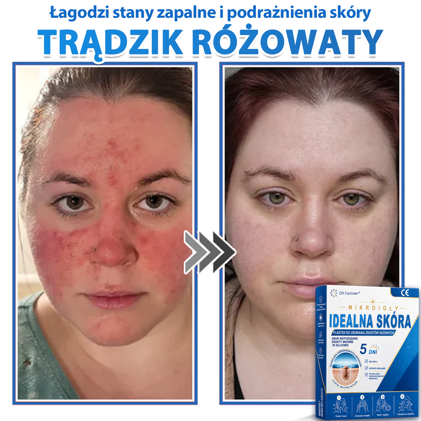 ✅📖 DR.Fachmer® Plaster mikroigłowy i hydrokoloid 2 w 1 | 👉Usuwające znamiona, trądzik, płaskie brodawki i zmiany skórne | Poprawia zmarszczki, blizny i przebarwienia | Niewidoczne plastry na pryszcze na twarz i ciało