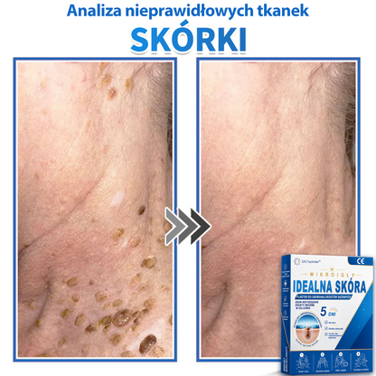 ✅📖 DR.Fachmer® Plaster mikroigłowy i hydrokoloid 2 w 1 | 👉Usuwające znamiona, trądzik, płaskie brodawki i zmiany skórne | Poprawia zmarszczki, blizny i przebarwienia | Niewidoczne plastry na pryszcze na twarz i ciało