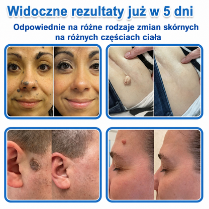 ✅📖 DR.Fachmer® Plaster mikroigłowy i hydrokoloid 2 w 1 | 👉Usuwające znamiona, trądzik, płaskie brodawki i zmiany skórne | Poprawia zmarszczki, blizny i przebarwienia | Niewidoczne plastry na pryszcze na twarz i ciało